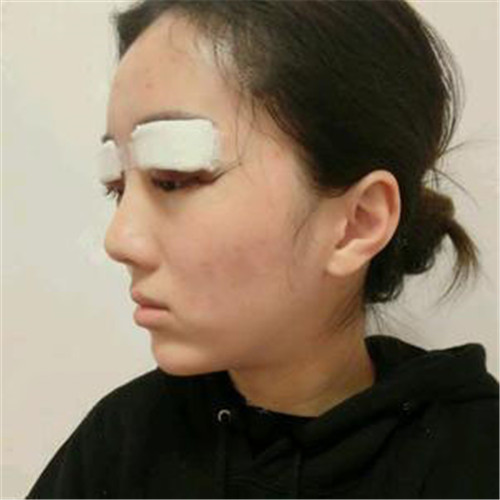 北京叶子汪环割双眼皮怎么样?案例_价格