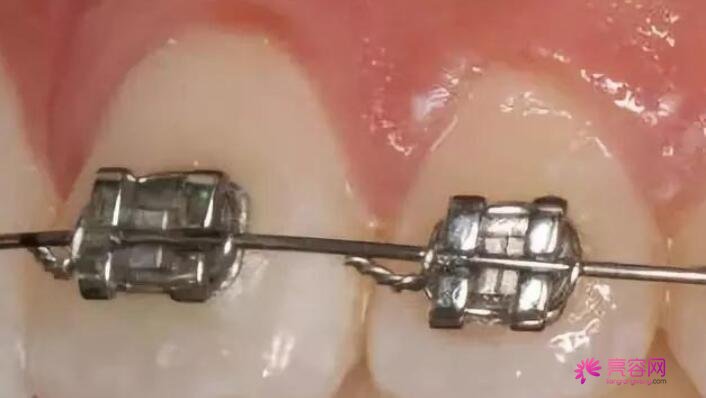格尔木市人民医院牙科怎么样？牙科医生信息+牙齿矫正果对比