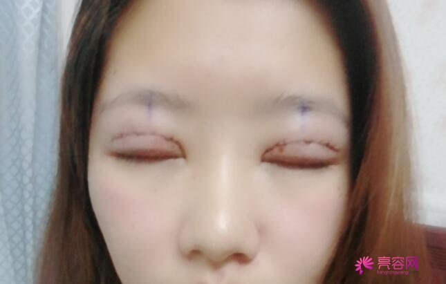 郑州安美星河整形医院技术怎么样？专家信息+双眼皮手术案例