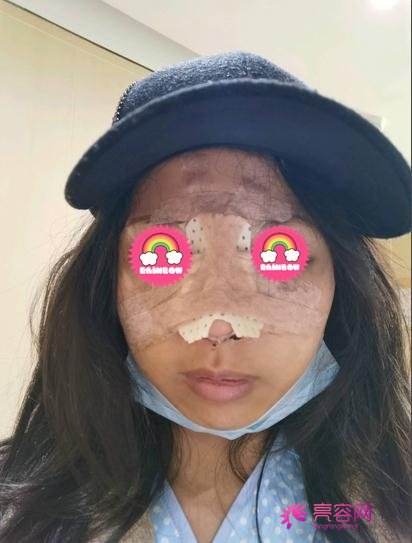 师俊莉做鼻子的案例，术后的我终于变漂亮了！短短3个月就拥有美鼻！
