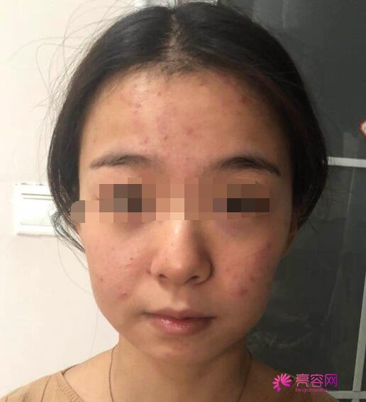 宁夏医科大学总医院整形美容科痘痘治疗前