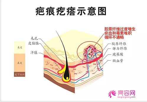 疤痕疙瘩