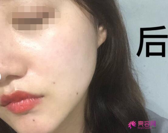 宁夏医科大学总医院整形美容科除皱