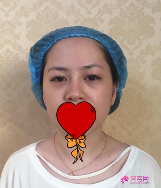超声提拉美容单次价格贵不贵呢？价格都和哪些因素有关呢？超声提拉案例