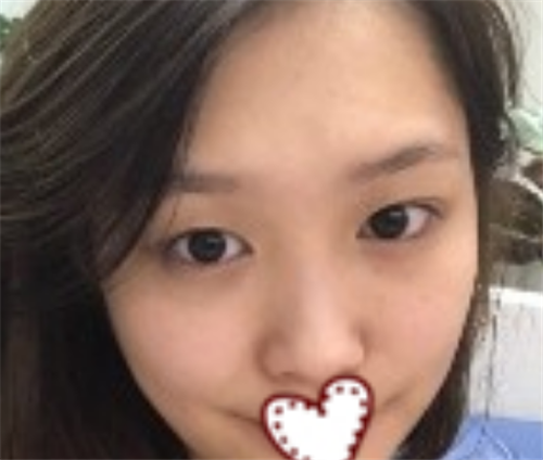 北京延世宋俊玲割双眼皮怎么样?案例_价格