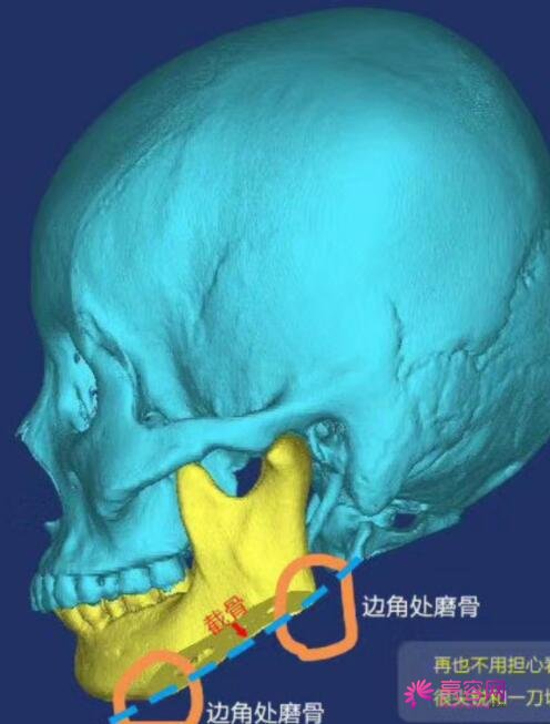 肥胖下颌角整容果好吗？一起来看真实下颌角磨骨的案例吧~超美！