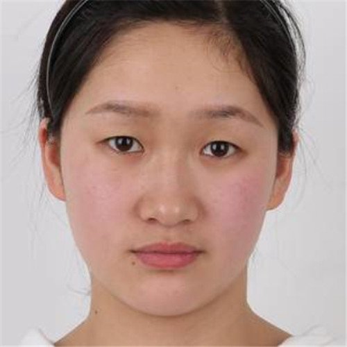 上海华美董亮割双眼皮怎么样?案例_价格
