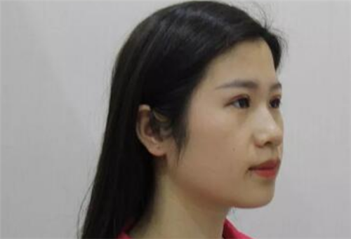 北京知音李奇军割双眼皮怎么样?案例_价格