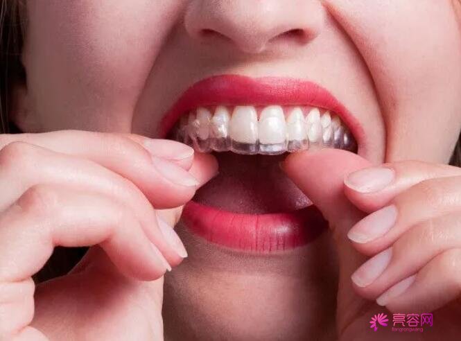 青海省人民医院口腔科马晨麟牙齿矫正怎么样？牙齿矫正前后对比果