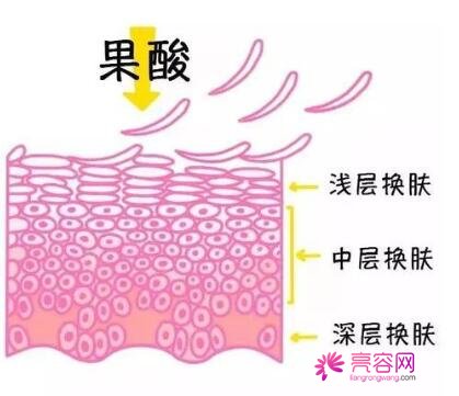 果酸除皱