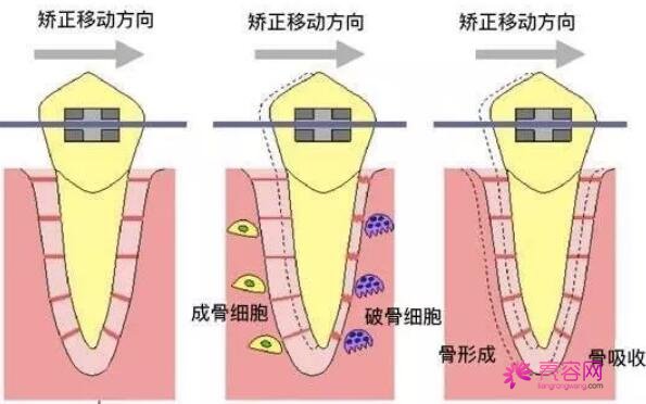 做牙齿矫正一定要拔牙吗