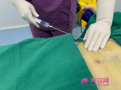 萍乡丽芙整形医院怎么样？张志宏医生简介+腰腹吸脂真实果