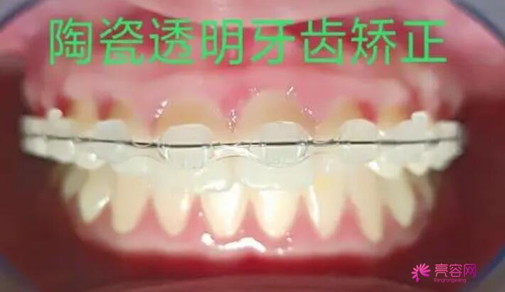 黔南州人民医院口腔科的实力怎么样？易相平医生评价+牙齿矫正案例