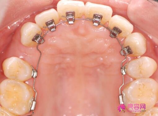 黔南州人民医院口腔科的实力怎么样？易相平医生评价+牙齿矫正案例