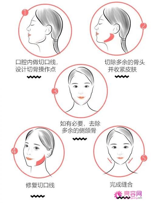 磨骨和整容手术的手术方法