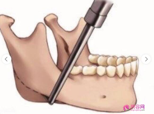 下颌角手术