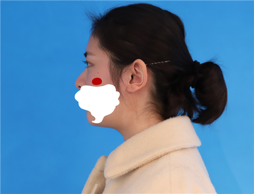 上海容妍张娟割双眼皮怎么样?案例_多少钱_口碑