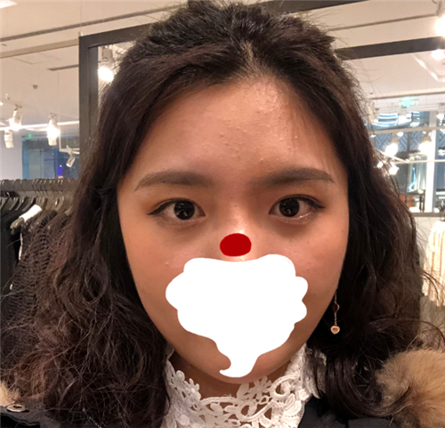 上海容妍张娟割双眼皮怎么样?案例_多少钱_口碑