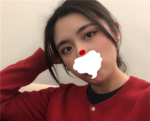 上海容妍张娟割双眼皮怎么样?案例_多少钱_口碑