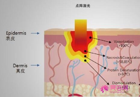 做彩光嫩肤好不好？这项技术可以调节什么？做彩光嫩肤的注意事项