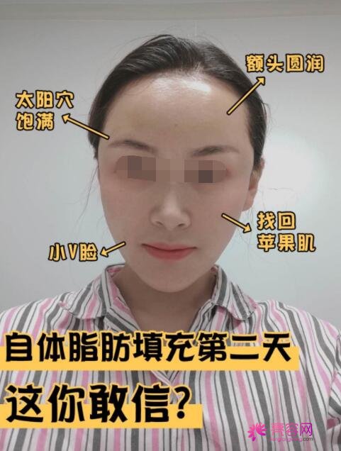 陈万芳脂肪填充真实手术后