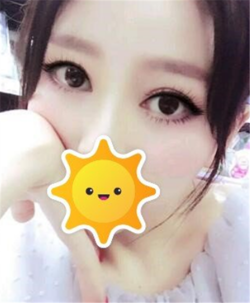 北京克莱美舍割双眼皮怎么样?案例_多少钱_口碑