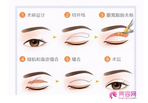 全切双眼皮原理图解?有哪些事项需要注意的呢?内附全切双眼皮案例