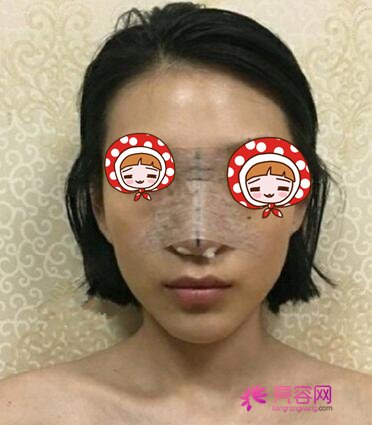 铭医孙轶峰做过的图片，隆鼻手术原来是这样完成