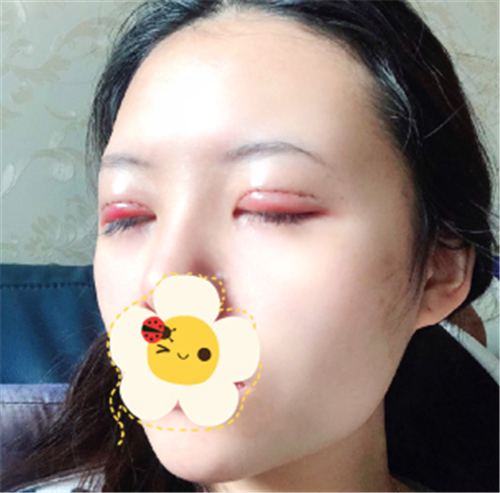 上海容妍柴云割双眼皮怎么样?案例_多少钱_口碑
