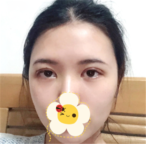 上海容妍柴云割双眼皮怎么样?案例_多少钱_口碑