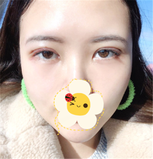 上海容妍柴云割双眼皮怎么样?案例_多少钱_口碑