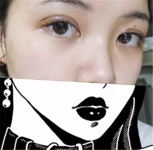 上海容妍柴云割双眼皮怎么样?案例_多少钱_口碑