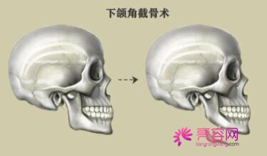 磨骨改脸型手术