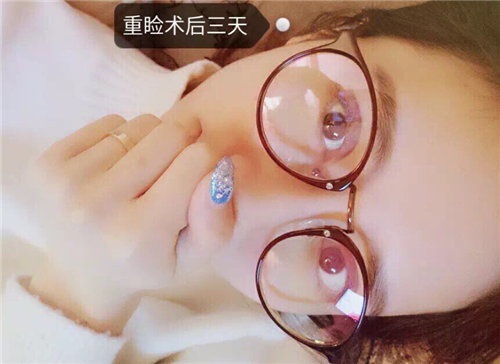 北京煤炭总医院割双眼皮怎么样?案例_多少钱_口碑