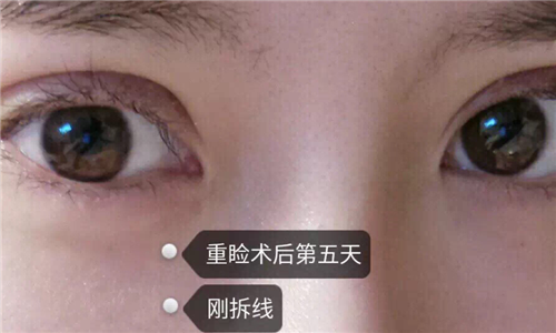 北京煤炭总医院割双眼皮怎么样？案例_多少钱_口碑
