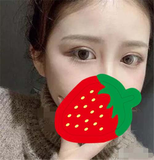上海联合丽格杜园园割双眼皮怎么样?案例_多少钱_口碑