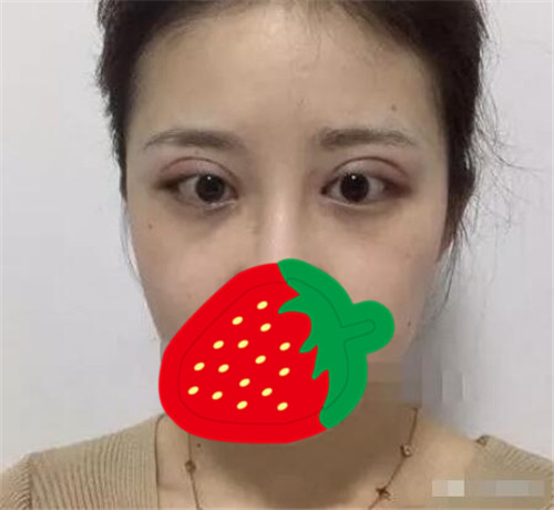 上海联合丽格杜园园割双眼皮怎么样?案例_多少钱_口碑