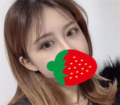 上海联合丽格杜园园割双眼皮怎么样?案例_多少钱_口碑