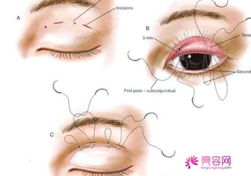 芭比双眼多宽才合适？芭比双眼皮整形包含哪些项目？快来详细的看一下