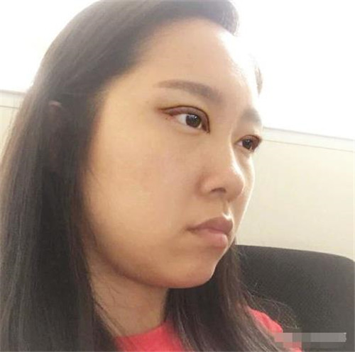 上海伯思立周珍艳割双眼皮怎么样?案例_多少钱_口碑