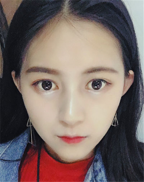上海联合丽格成浩割双眼皮怎么样?案例_多少钱_口碑
