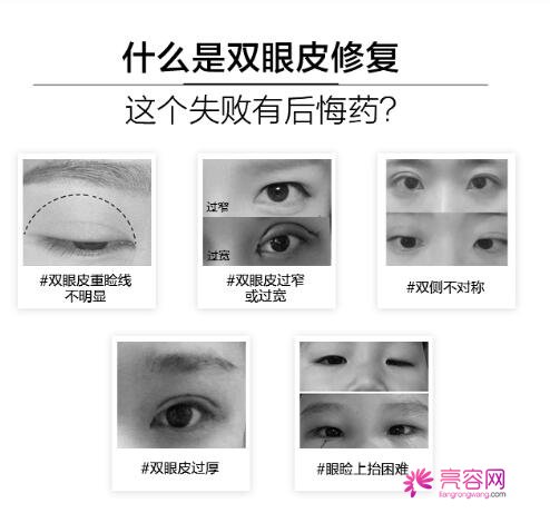 双眼皮深改浅修复图~来看个人真实案例及双眼皮修复的注意事项~