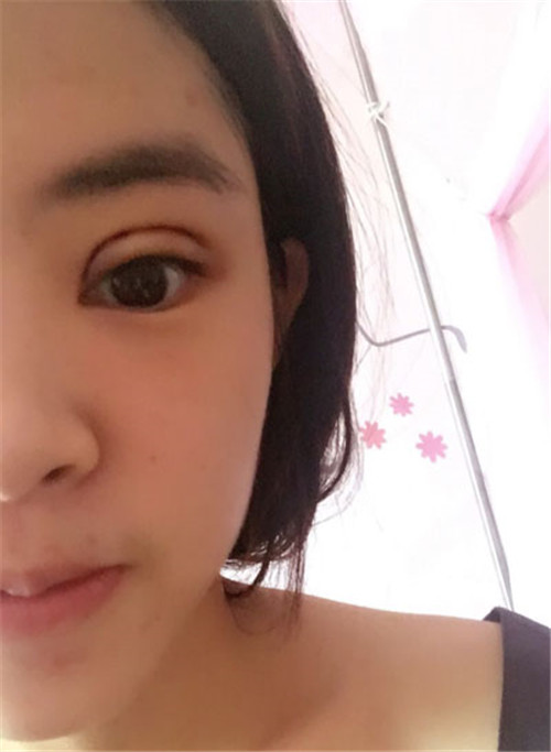 上海伯思立李茂群割双眼皮怎么样?案例_多少钱_口碑