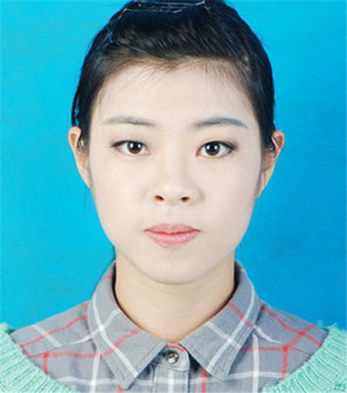 上海伯思立李茂群割双眼皮怎么样?案例_多少钱_口碑