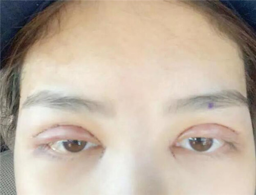 上海伯思立邵玉芳割双眼皮怎么样?案例_多少钱_口碑