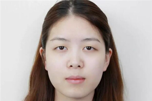 上海伯思立邵玉芳割双眼皮怎么样?案例_多少钱_口碑