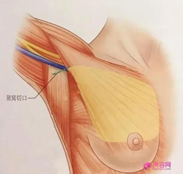 隆胸术后的风险和并发症