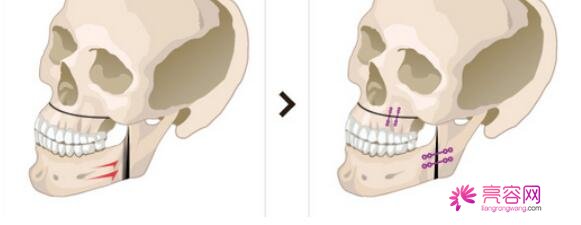 男性过大下颌角整形果好不好？来看手术前后变化：真的值得一做？