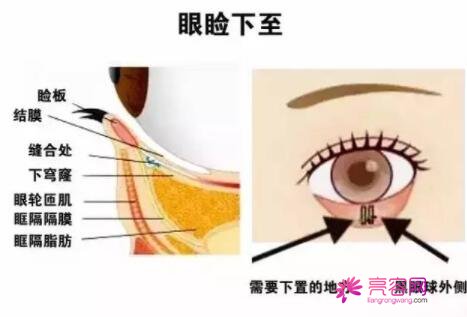 眼睑下至加提肌前后对比果图~内附真实经历分享：放大眼睛果惊人！