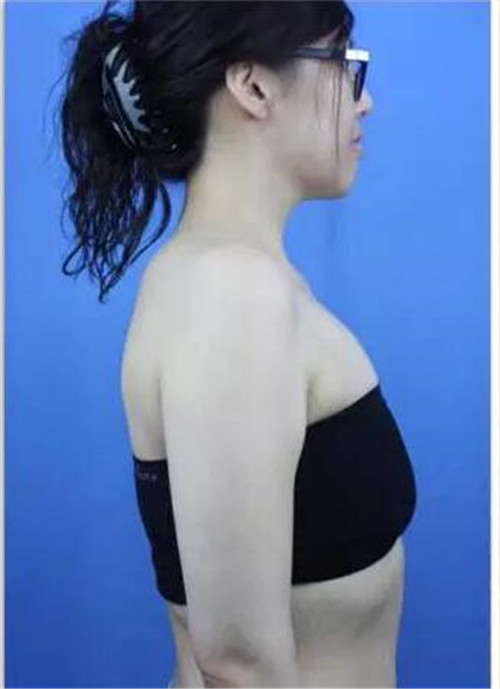 上海伊莱美李旭东隆胸怎么样?多少钱_案例_口碑